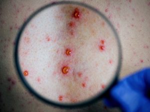 varicella viral infection