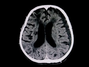 subdural hematoma diagnosis