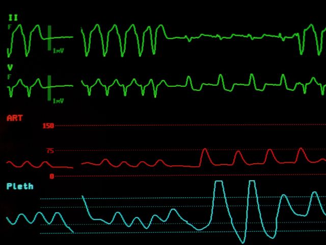 Neuroleptic Malignant Syndrome treatment